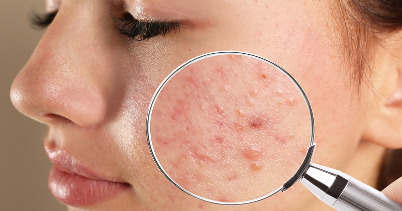 Diet Tips: 7 Tips That May Help To Reduce Acne