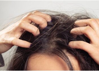 Ayurveda remedies to deal with dandruff in winter season