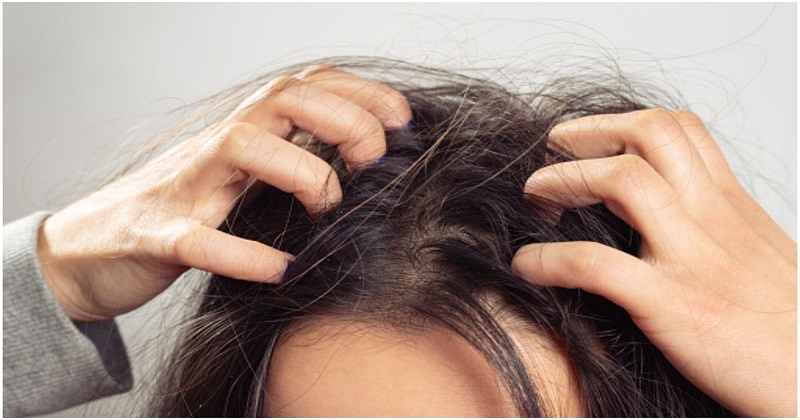 Ayurveda remedies to deal with dandruff in winter season