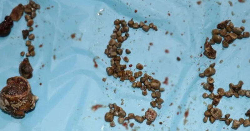 Hyderabad: Doctors Remove Record Number Of 156 Kidney Stones From A Single Patient