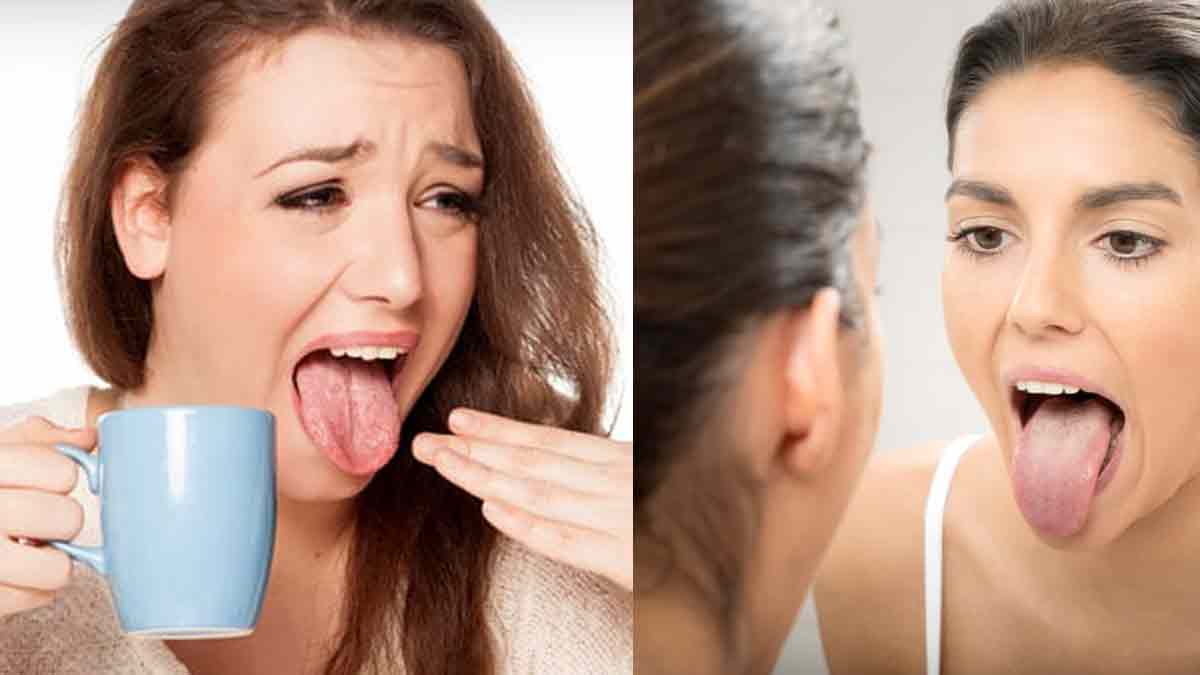Home Remedies to Heal Burnt Tongue tips to get relief from burnt Tongue health news