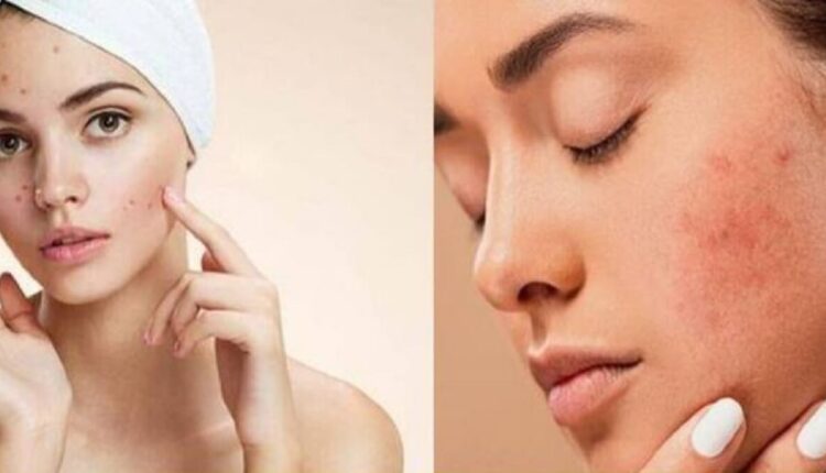 Pimples Symptoms: Even so! Pimples on the face say a surprising thing