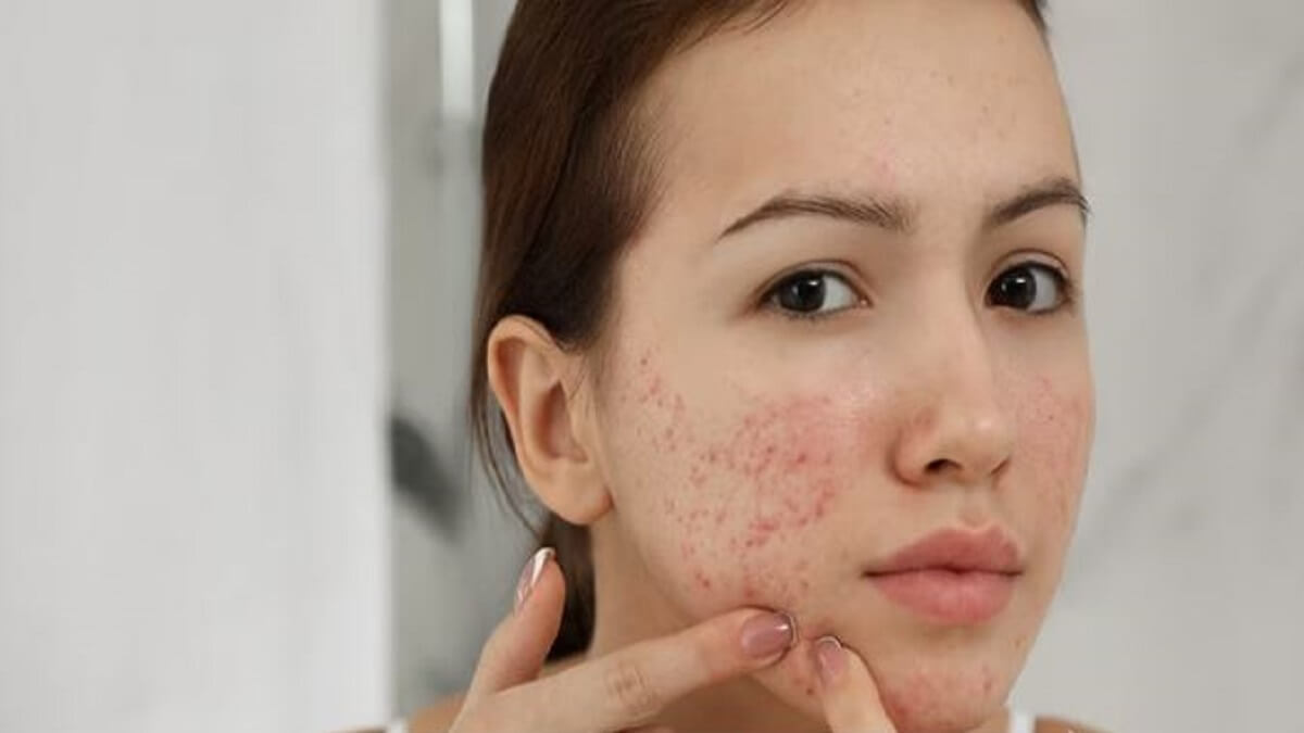 Pimples Symptoms: Even so! Pimples on the face say a surprising thing