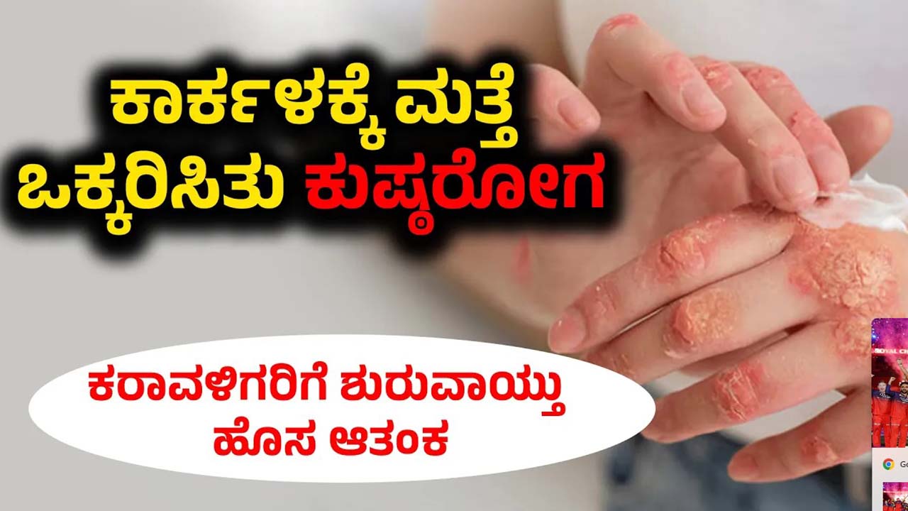 Leprosy Spreads in Karkala Consult a Doctor if These Symptoms Appear