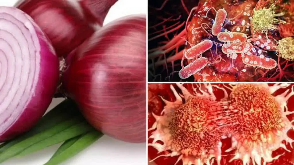 Onion Cancer